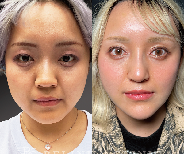 小顔脂肪吸引No4049