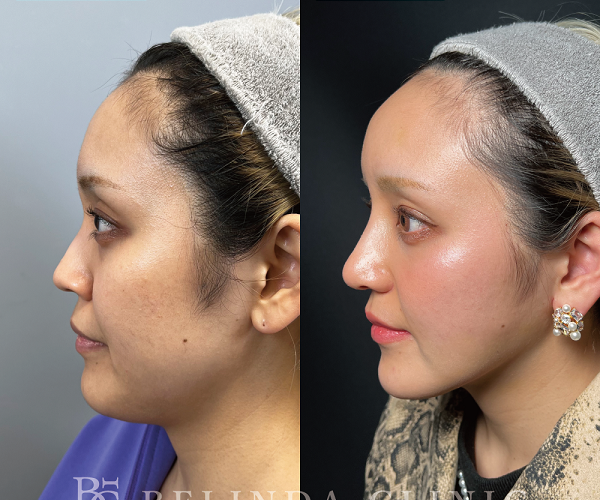 小顔脂肪吸引No4049_2