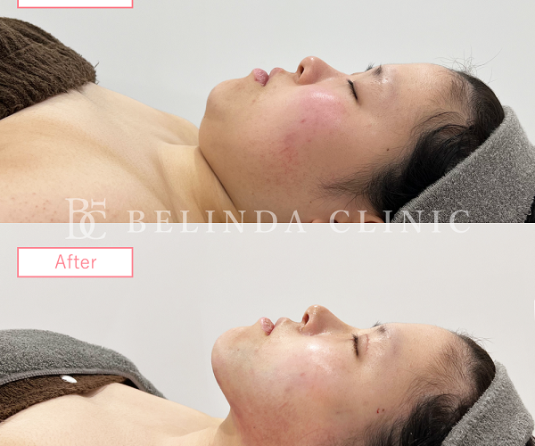 小顔脂肪吸引No4137