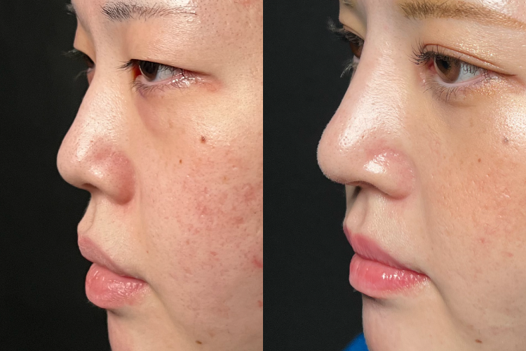 鼻中隔延長No3653