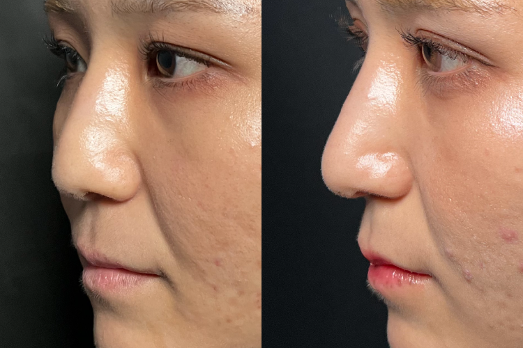 鼻中隔延長No3661