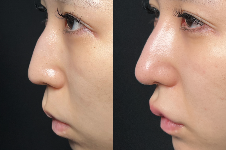 鼻中隔延長No3857