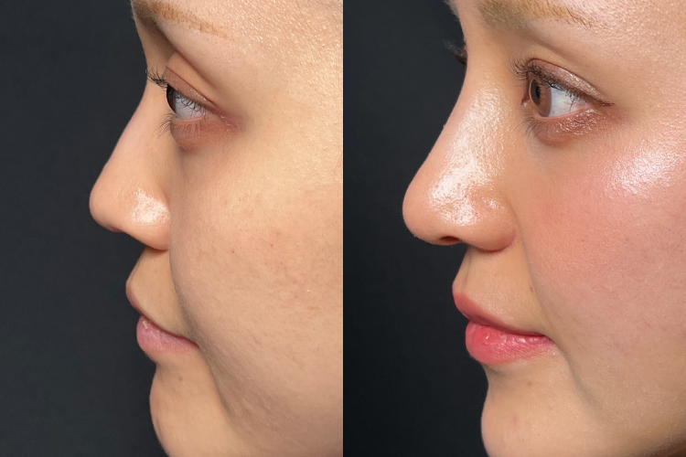 鼻中隔延長No4049