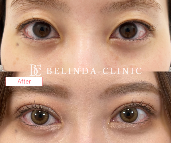 二重整形埋没法症例No1125