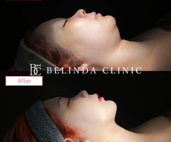 小顔脂肪吸引No5817