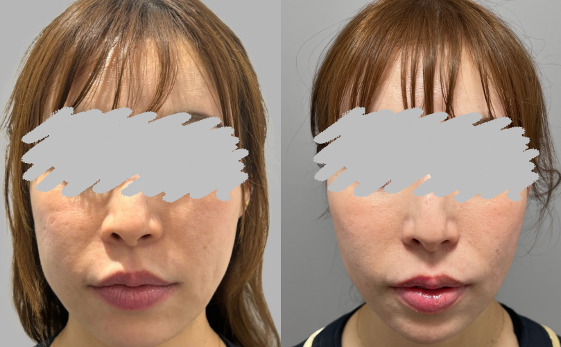 糸リフト症例No1014