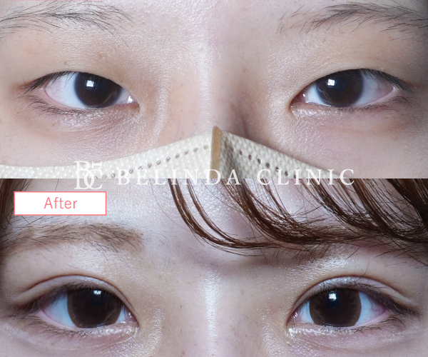 二重整形埋没法症例No6231