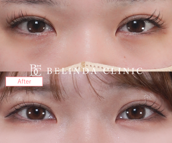 切らないクマ取りたるみ取り症例No935