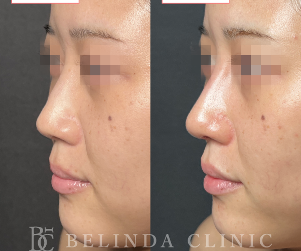 鼻中隔延長術症例No_staff01