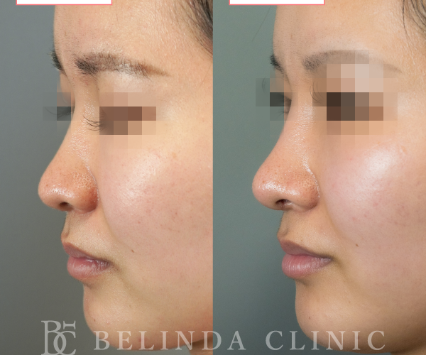 鼻中隔延長術症例No_staff02