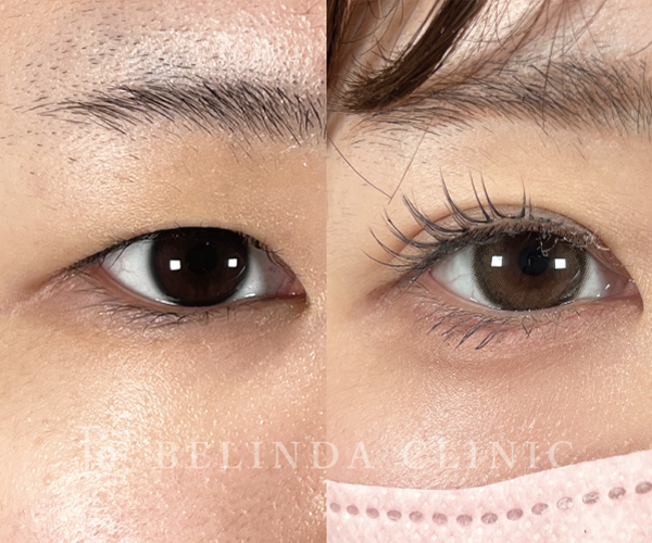 二重整形埋没法症例No547