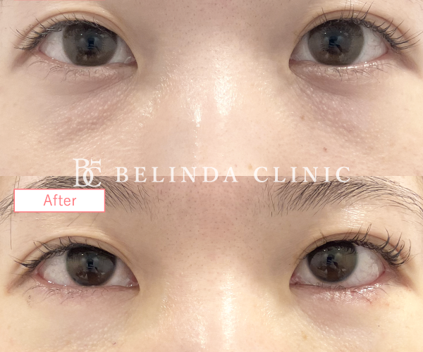 切らないクマ取りたるみ取り症例No5983