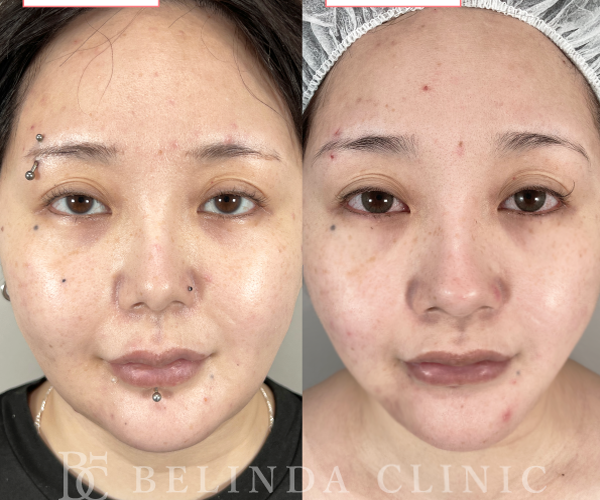 小顔脂肪吸引症例No639