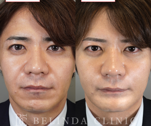 糸リフト症例No6772