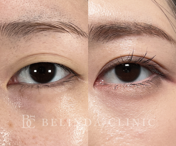 二重整形埋没法症例No691