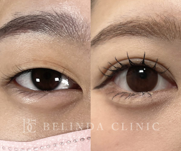 二重整形埋没法症例No704