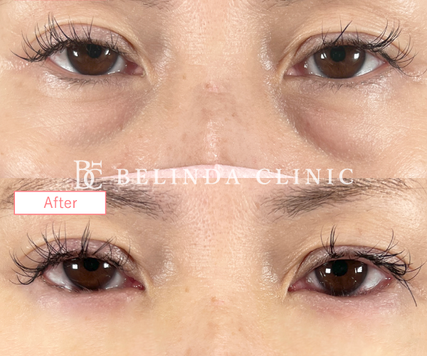 切らないクマ取りたるみ取り症例No769