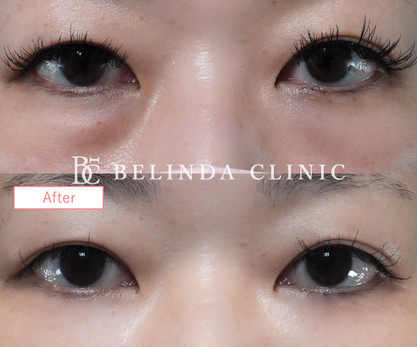 切らないクマ取りたるみ取り症例No857