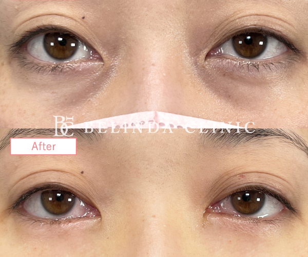 切らないクマ取りたるみ取り症例No976