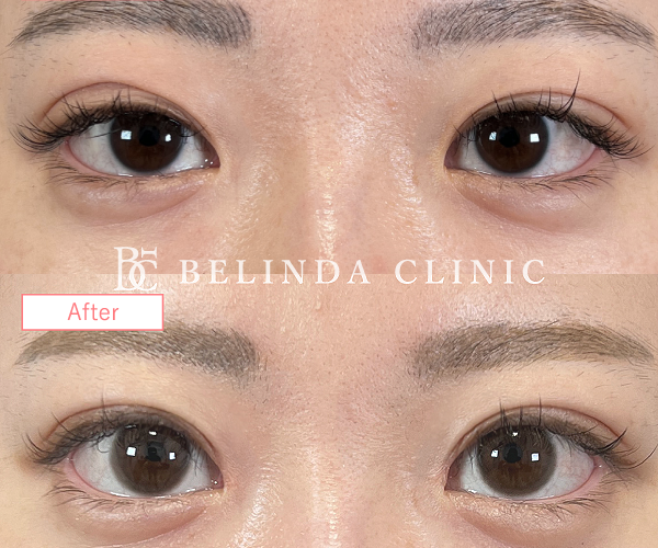 目上切開症例staff