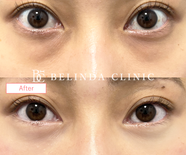 切らないクマ取りたるみ取り症例No6531