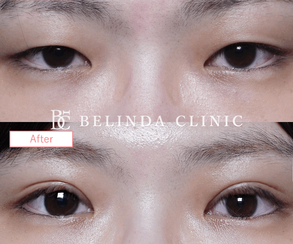 二重整形埋没法症例No6610