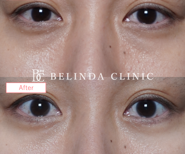 切らないクマ取りたるみ取り症例No6829