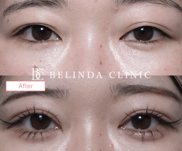 二重整形埋没法症例No7121