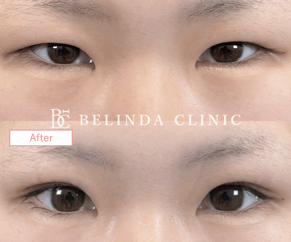 二重整形埋没法症例No7130