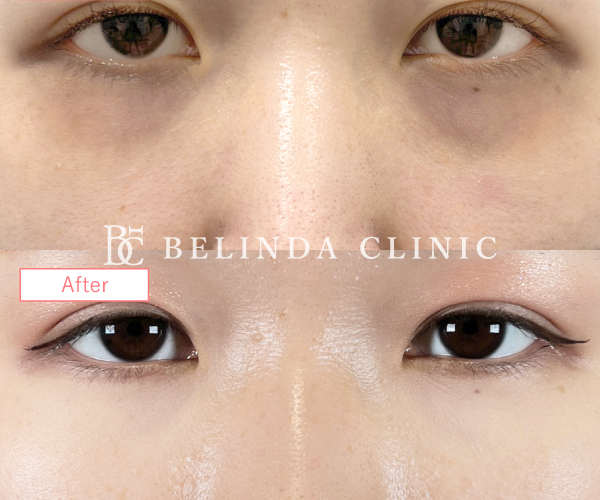 切らないクマ取りたるみ取り症例No7244