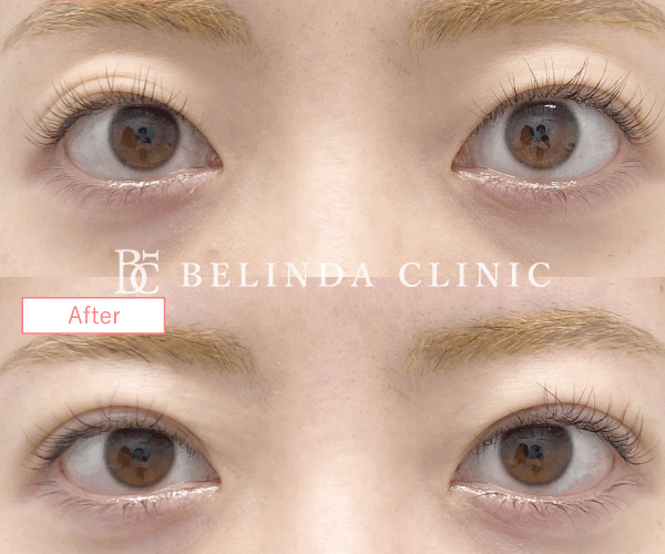 二重整形埋没法症例No7558