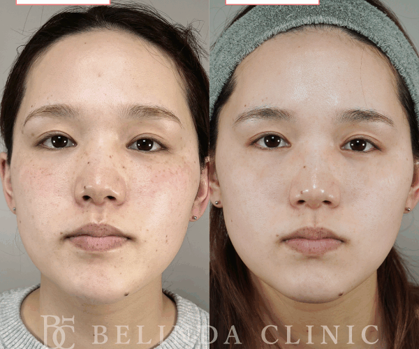 ルメッカ症例No1097