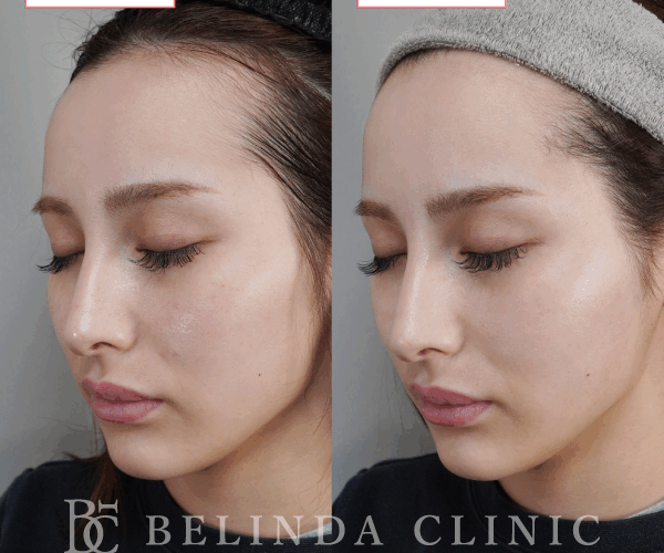 ルメッカ症例No1102