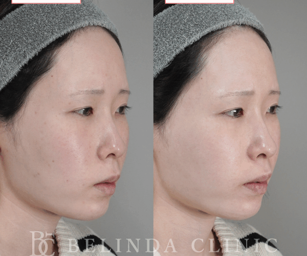 ルメッカ症例No1110