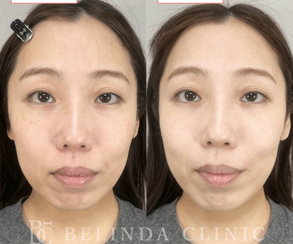 ルメッカ症例No1112