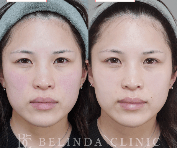 ルメッカ症例No1116