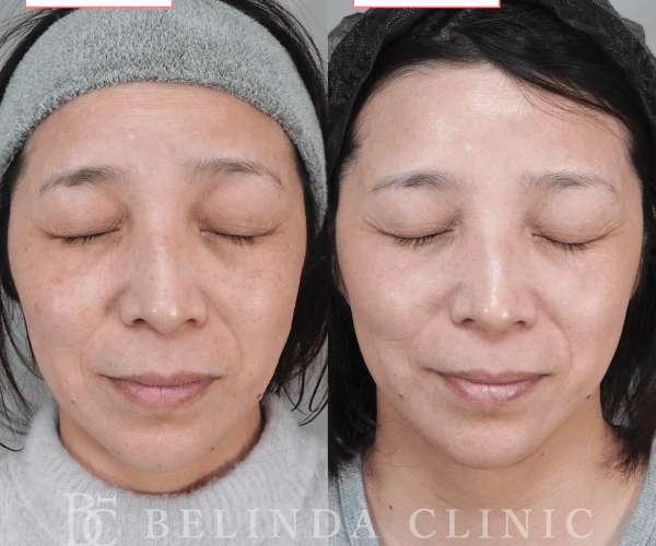 ルメッカ症例No1143