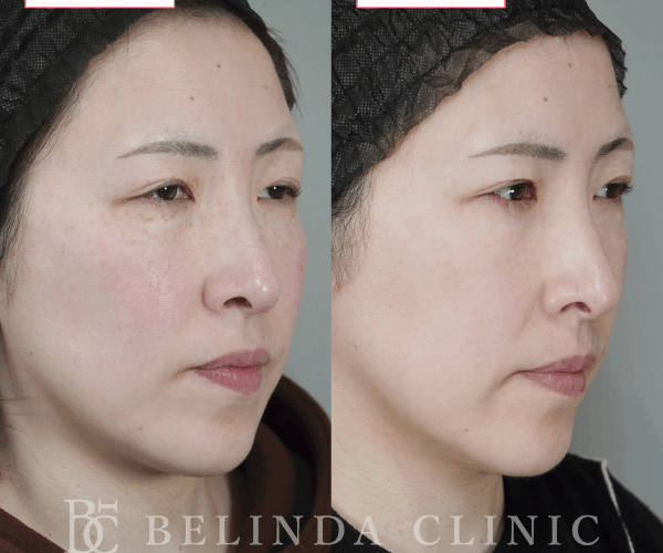 ルメッカ症例No1192