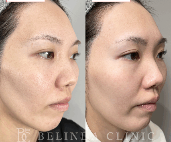 ルメッカ症例No722