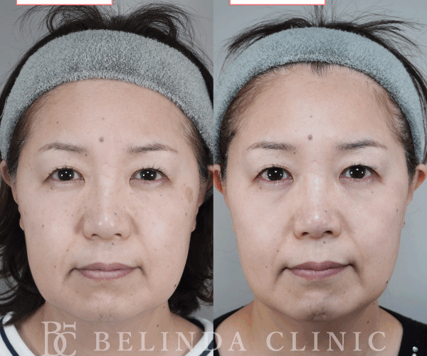 ルメッカ症例No733