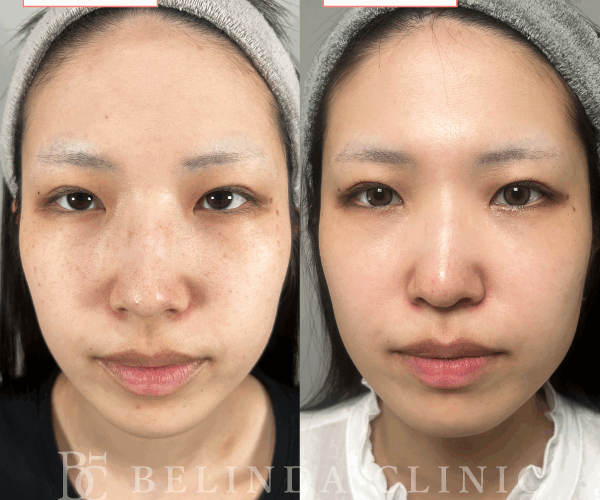 ルメッカ症例No756