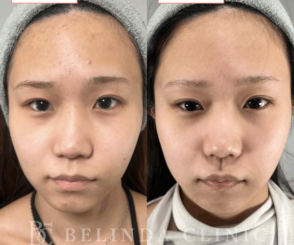 ルメッカ症例No869