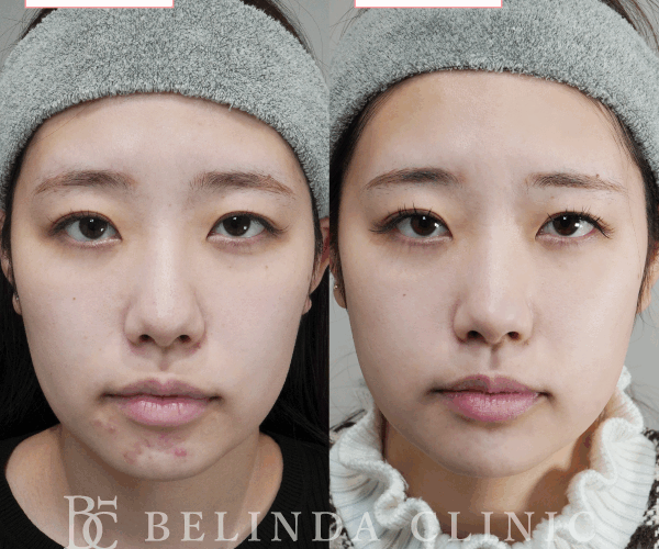 ルメッカ症例No946