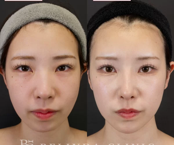 鼻尖形成・鼻プロテーゼ