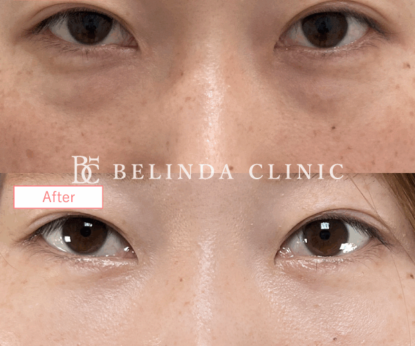 切らないクマ取り・裏ハムラ法症例No1296