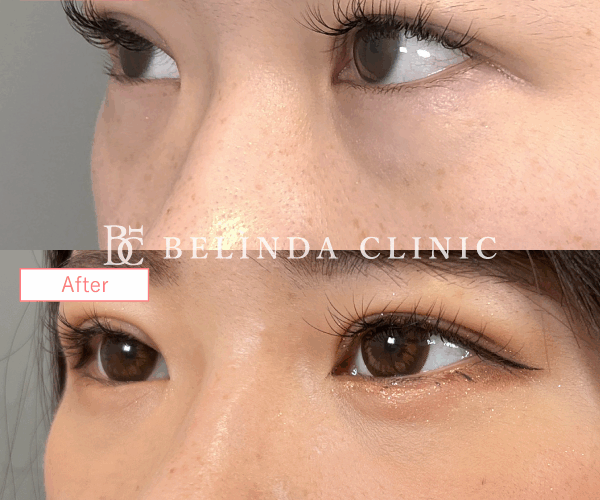 クマ取り症例No1411