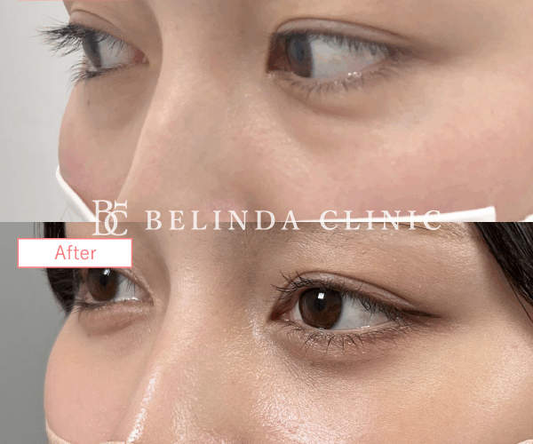 切らないクマ取りたるみ取り症例No2377