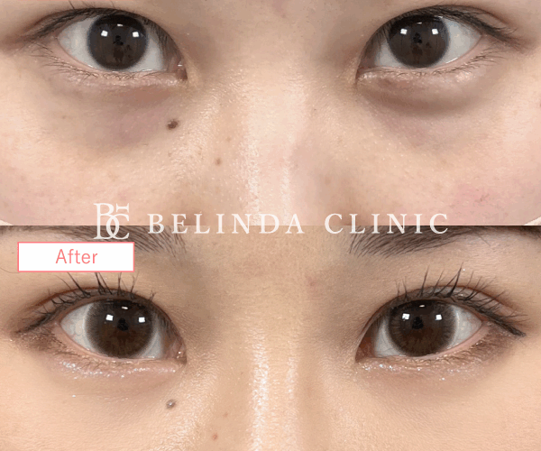 切らないクマ取りたるみ取り症例No2886