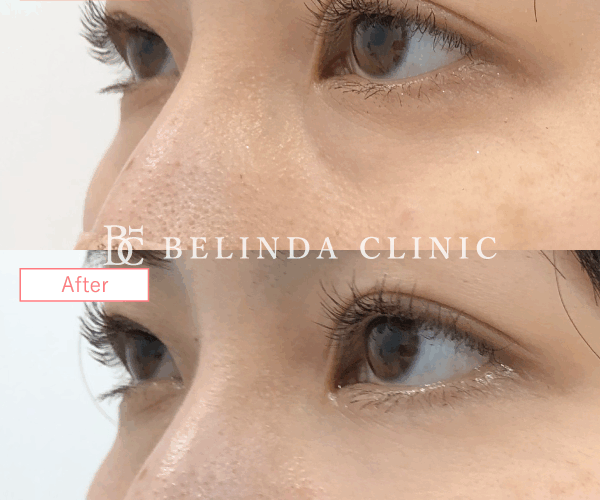 切らないクマ取りたるみ取り症例No3054