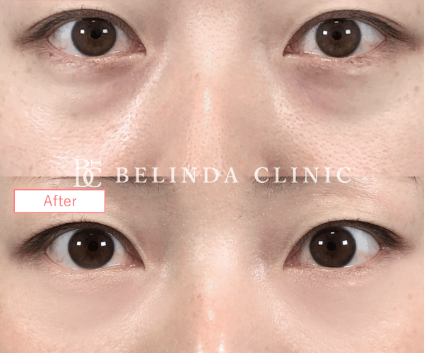 切らないクマ取りたるみ取り症例No3373